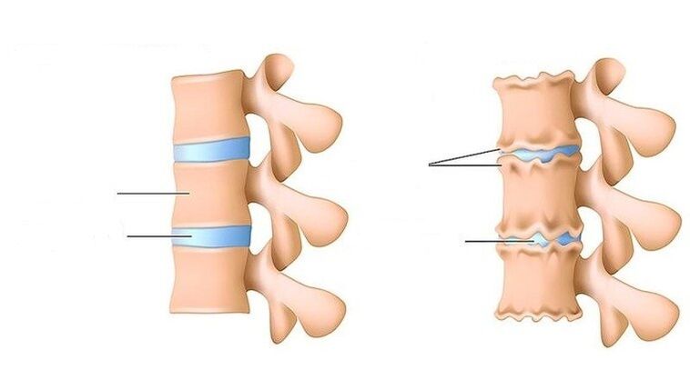 healthy spine affected by osteochondrosis