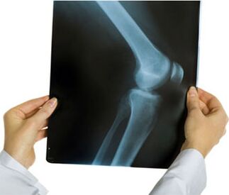 X-ray of knee osteoarthritis